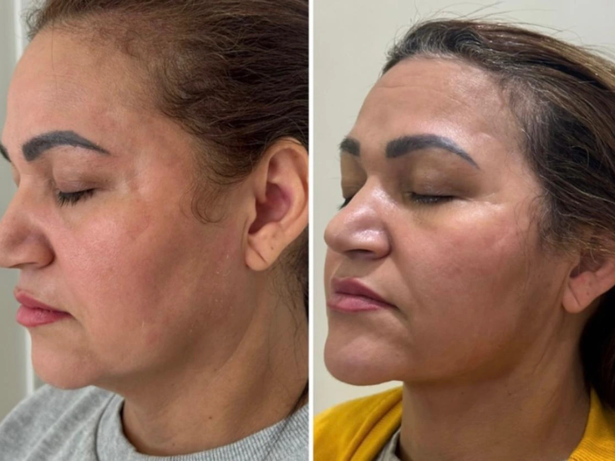 Antes e depois de resultado clínico publicado pela Dra. Isabel — visão de perfil