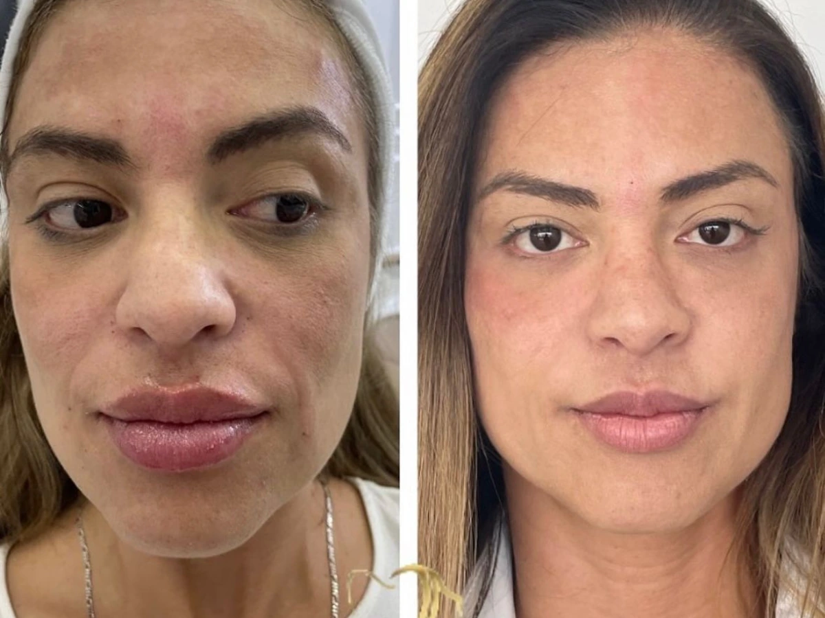 Antes e depois de resultado clínico publicado pela Dra. Isabel — visão frontal